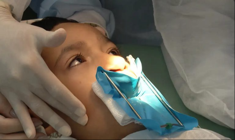 SUS ará a oferecer cirurgia reconstrutiva de lábio leporino